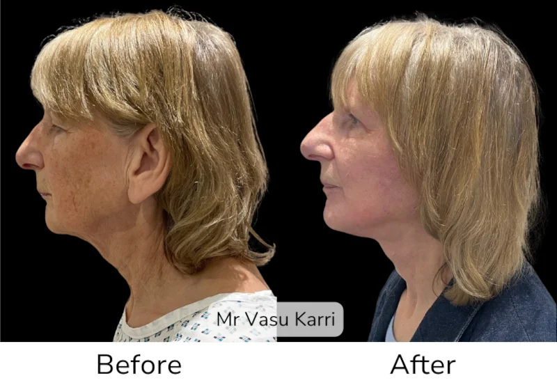 Facelift Patient 9 View 2